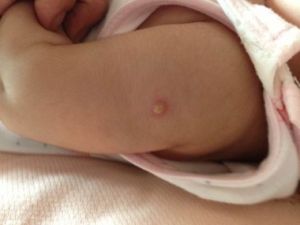 卡介苗接種反應(yīng) - 用來預(yù)防兒童結(jié)核病的預(yù)防接種疫苗