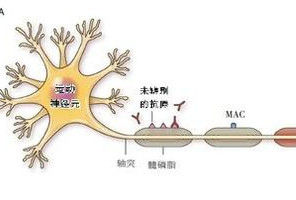 吉蘭巴雷綜合征 - 自身免疫性周圍神經(jīng)病