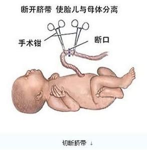 剖宮產(chǎn) - 產(chǎn)科領(lǐng)域中的重要手術(shù)