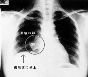 肺癌 - 惡性腫瘤