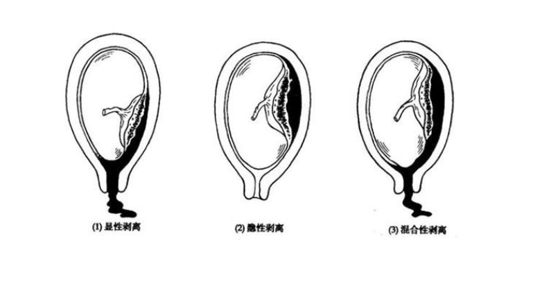 胎盤早剝 - 妊娠晚期的嚴(yán)重并發(fā)癥