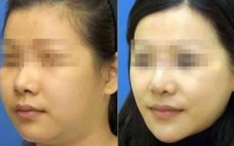 吸脂手術 - 外科體形雕塑手術中的一種